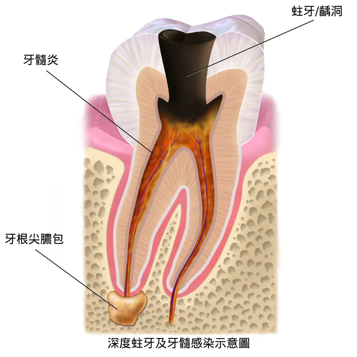 1200px-Blausen_0864_ToothDecay.png