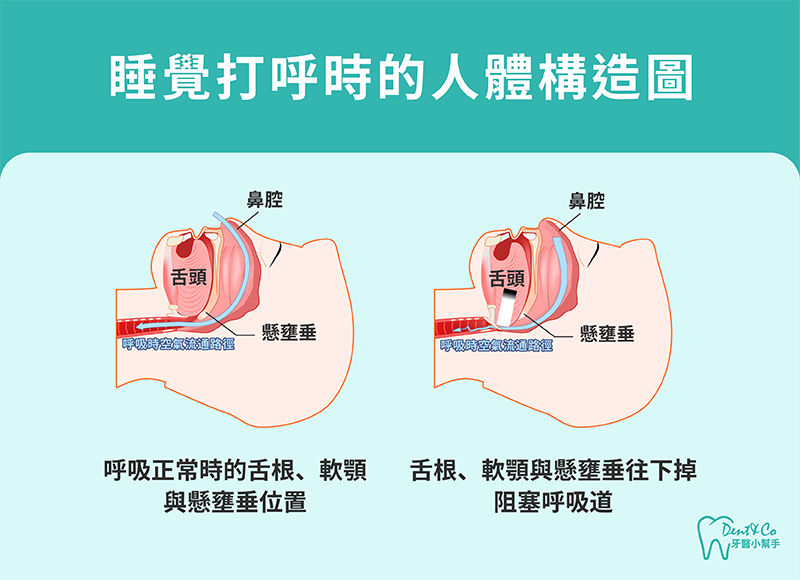 250822_部落格文章_打呼與睡眠呼吸中止症的差別是什麼?原因、症狀與風險一次看懂_內文圖片-1.png