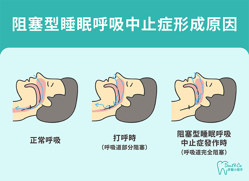 250826_部落格文章_打呼與睡眠呼吸中止症的差別是什麼?原因、症狀與風險一次看懂_內文圖片-3.png