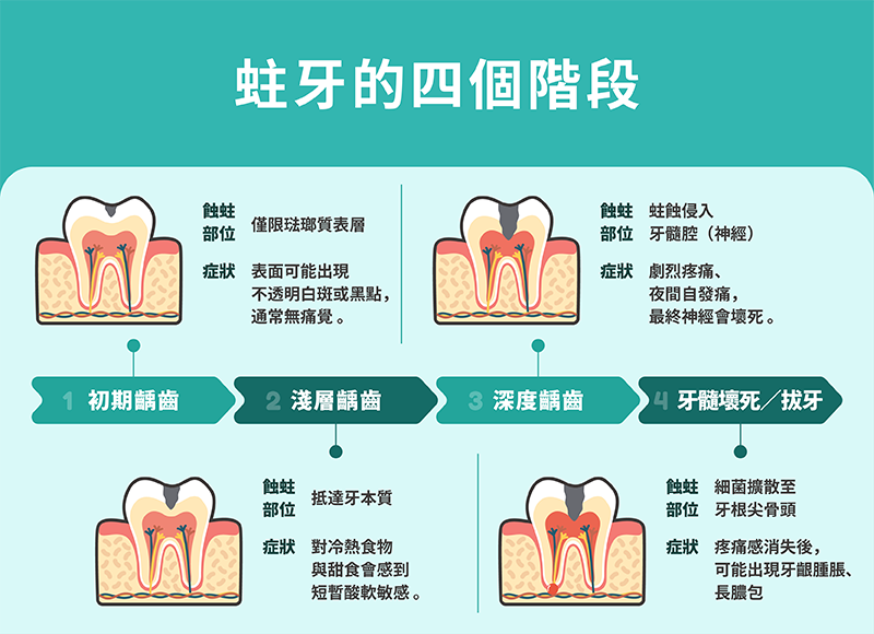 251124_部落格文章_牙齒有小黑洞?小心「5大齲齒前兆」!本文教你判別蛀牙病程,避開根管危機_內文圖片-2.png