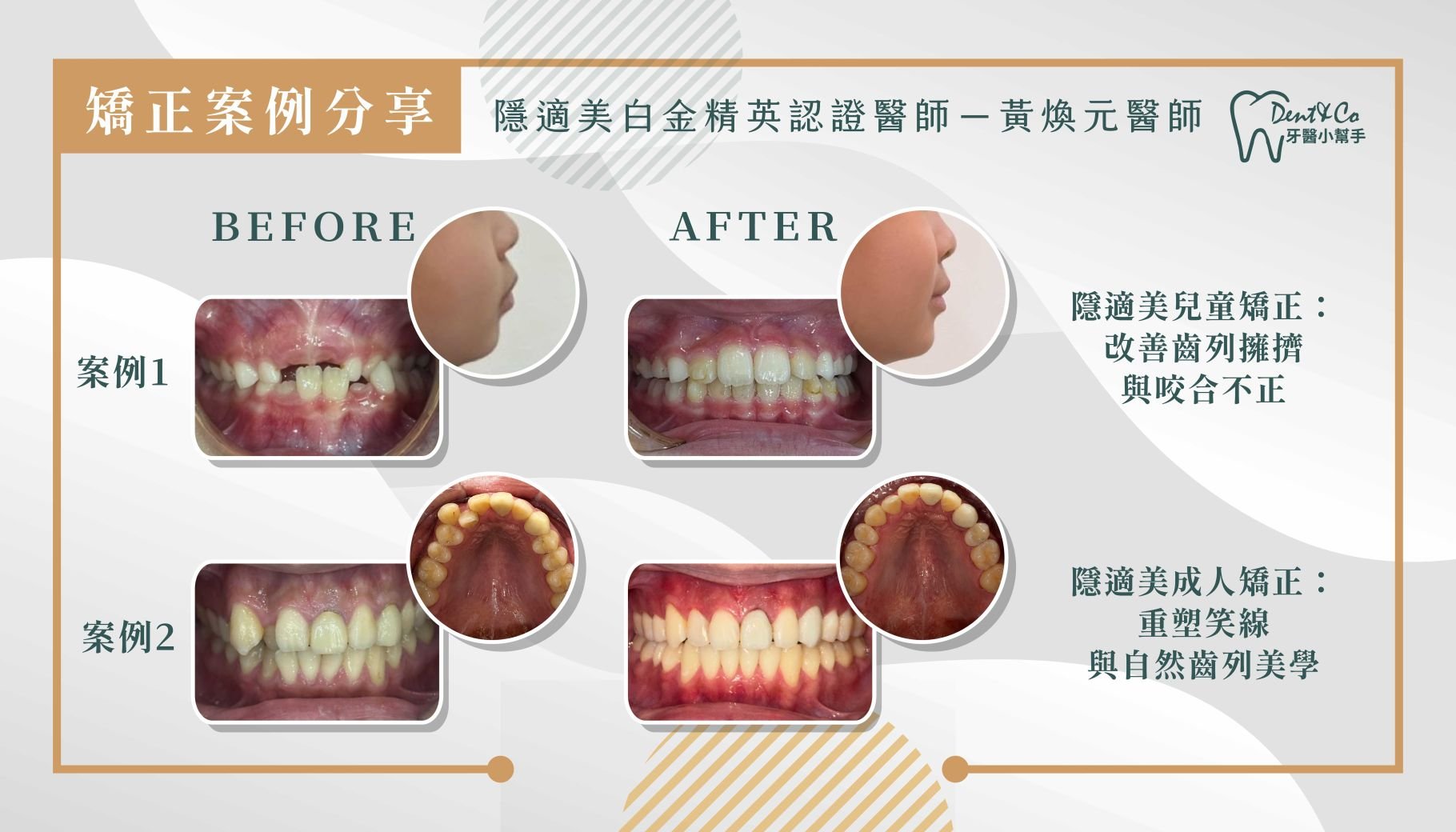 黃煥元醫師-桃園矯正推薦 台北牙齒矯正推薦 新北牙齒矯正 台南矯正牙齒推薦 牙齒矯正案例