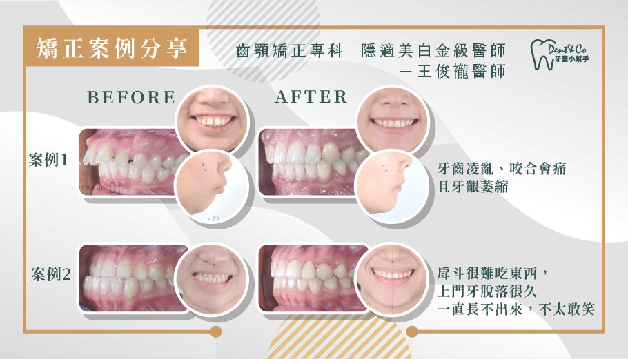 隱適美矯正案例展示_王俊襱醫師 (1).jpg
