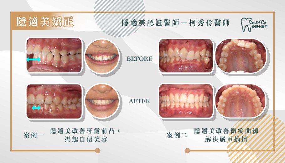 隱適美矯正案例_柯秀伶.jpg