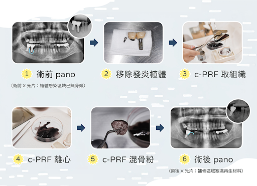 補骨手術流程c-PRF.png
