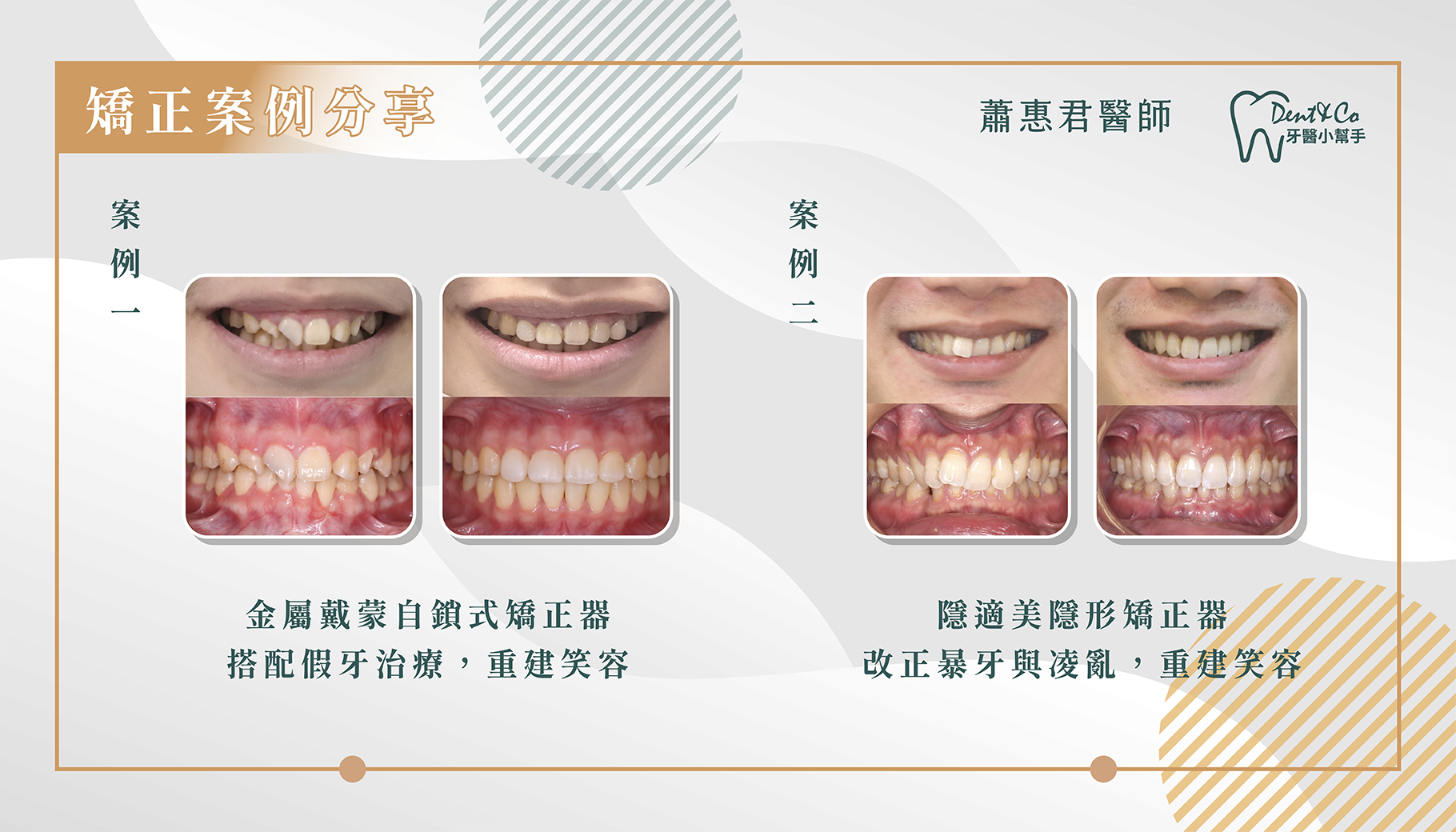 部落格文章_矯正醫師文章_蕭惠君_案例展示_蕭惠君_02.png