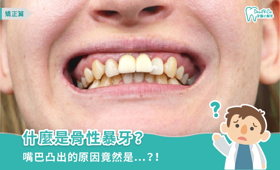 深入解析骨性暴牙：從判斷到矯正，一次掌握