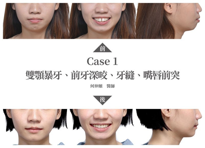 何仲頤醫師矯正案例1-1.jpg