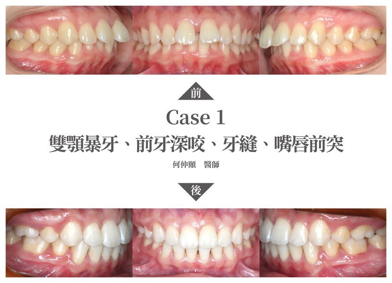 何仲頤醫師矯正案例1-2.jpg