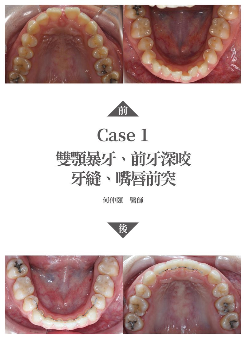 何仲頤醫師矯正案例1-3.jpg
