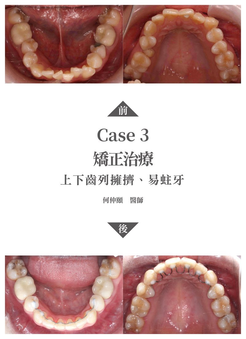 何仲頤醫師矯正案例3.jpg