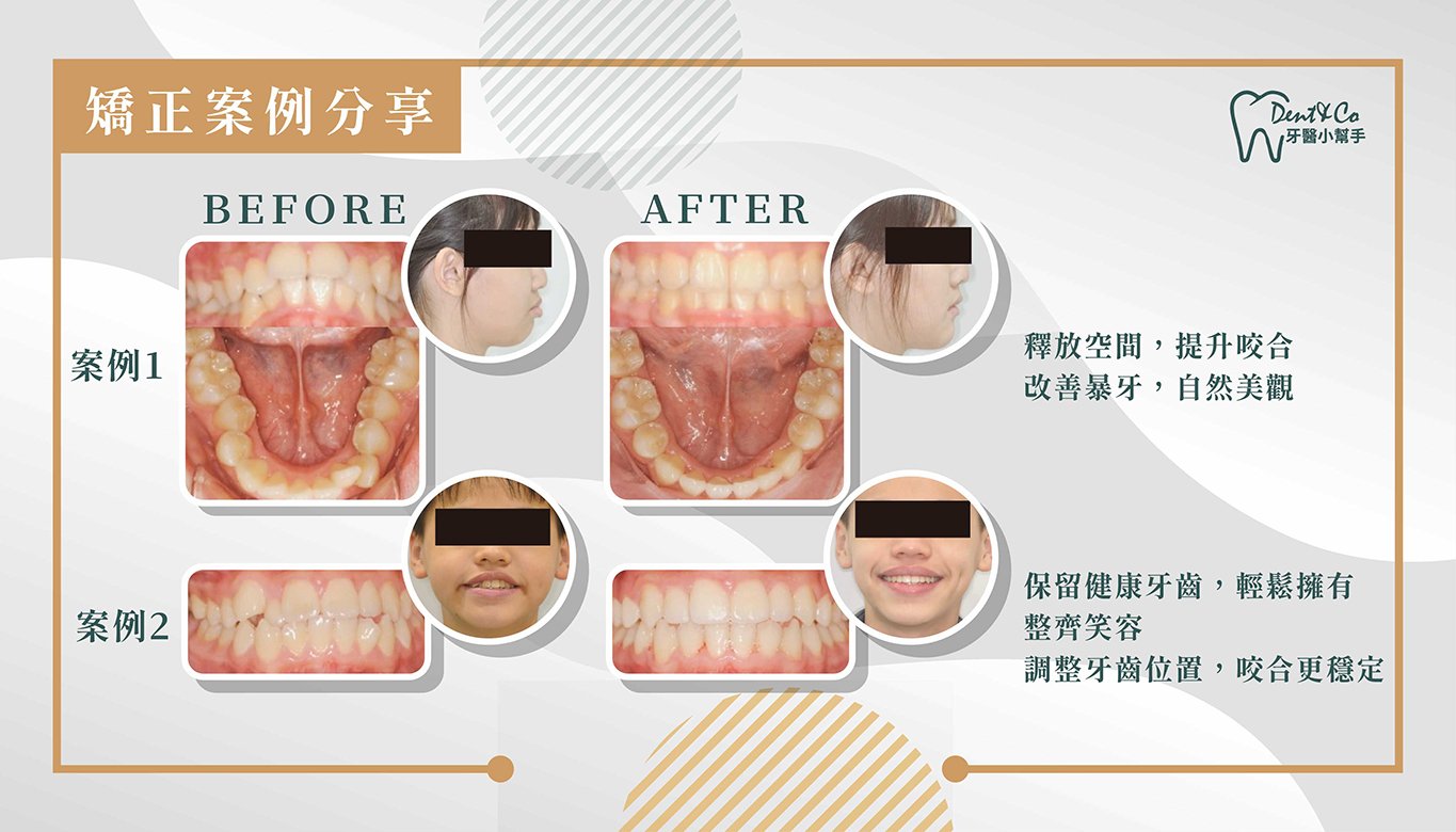 矯正醫師推薦-賴信池案例圖0326_2.jpg