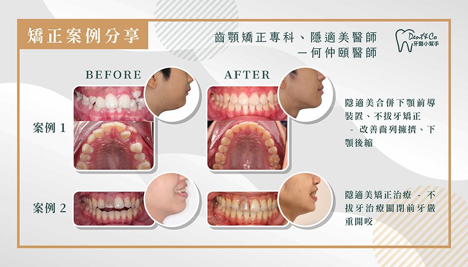矯正醫師推薦 - 何仲頤案例圖修改.jpg