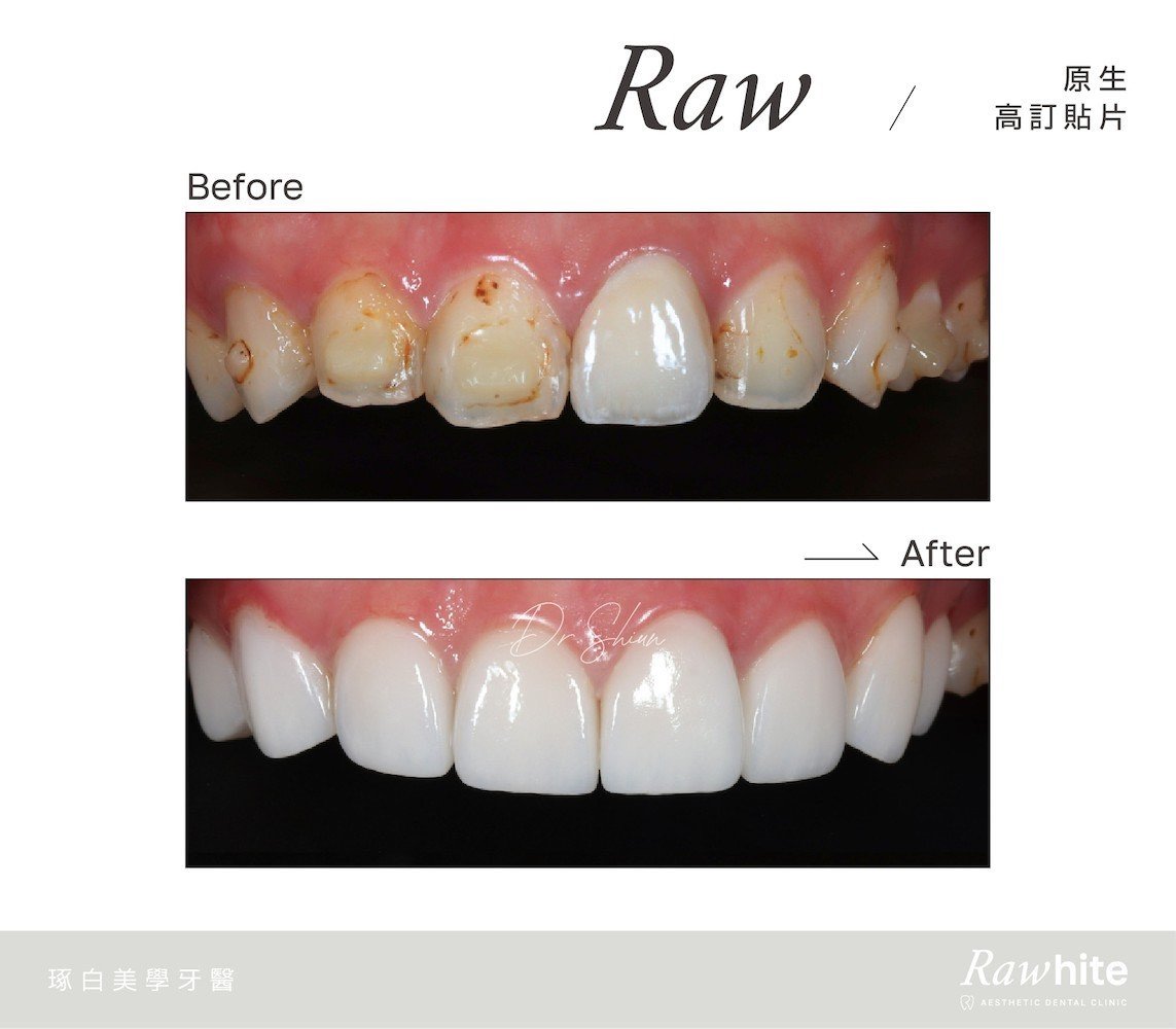 林孟勳醫師-原生高訂貼片案例2（矯正後色澤不均）.jpg