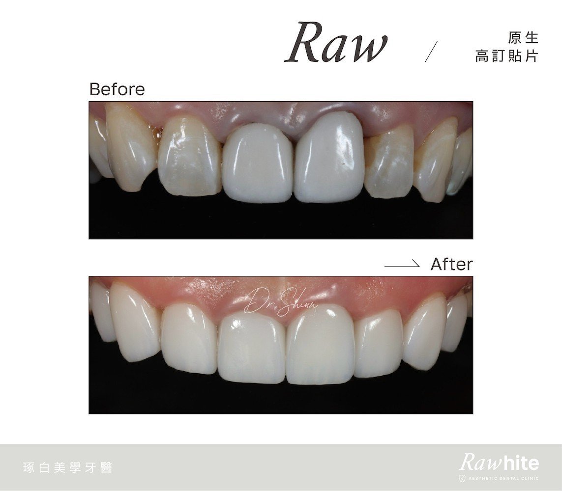 林孟勳醫師-原生高訂貼片案例3（門牙全瓷冠保護混合貼片美化）.jpg