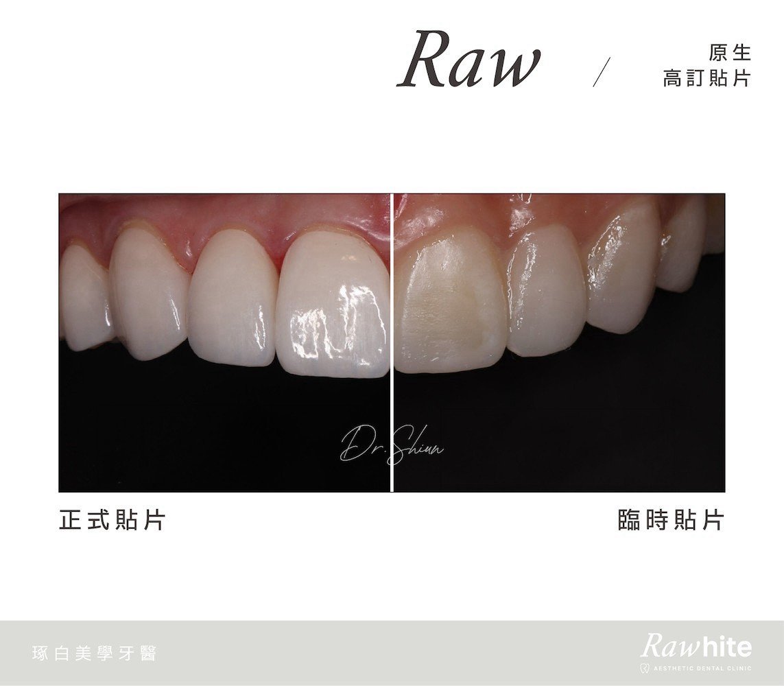 林孟勳醫師-原生高訂貼片案例5（正式貼片vs.臨時貼片）.jpg