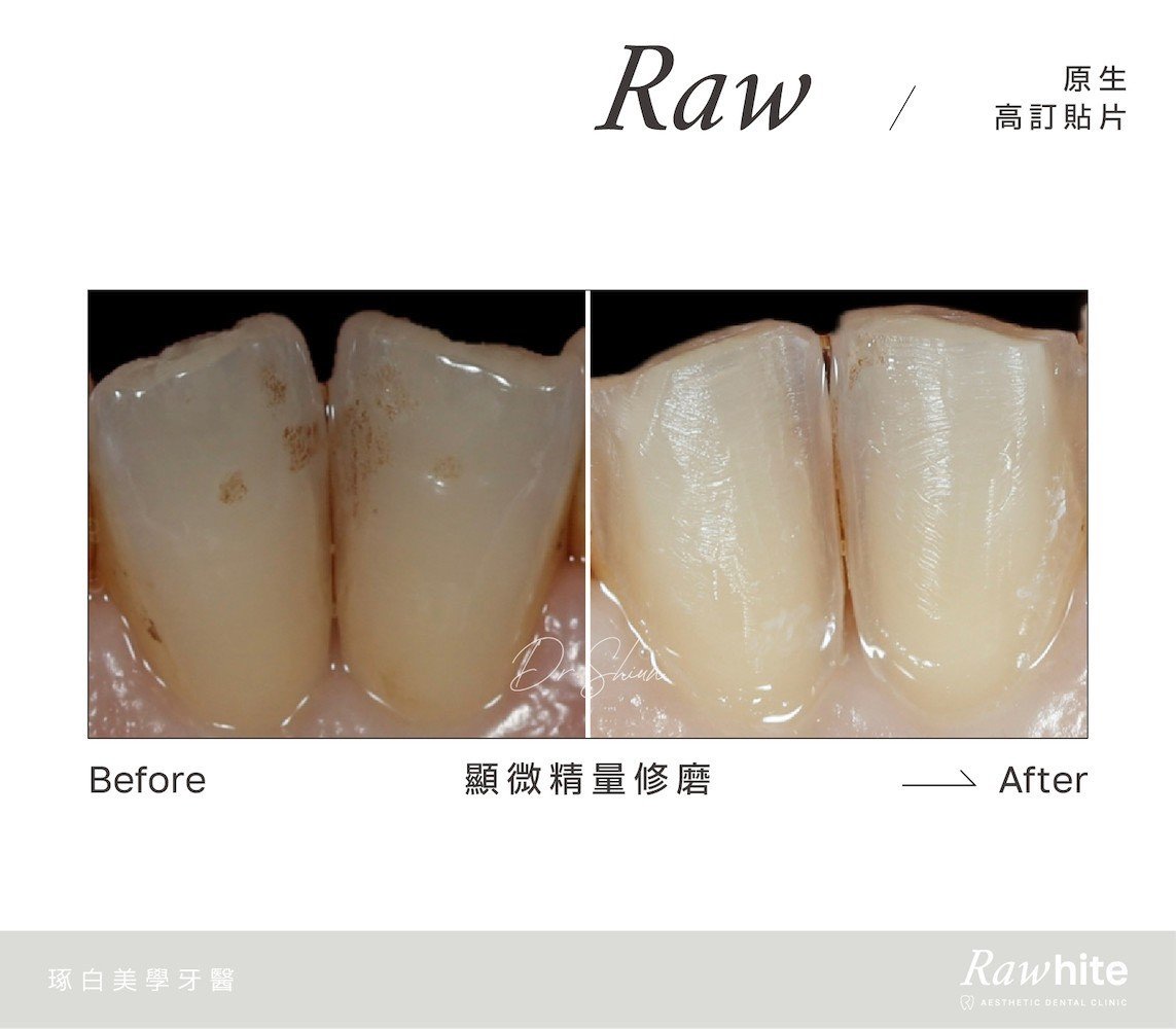 林孟勳醫師-原生高訂貼片案例6（顯微精量修磨）.jpg