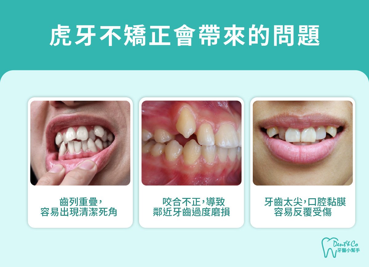 內文圖片-虎牙不矯正會帶來的問題.jpg