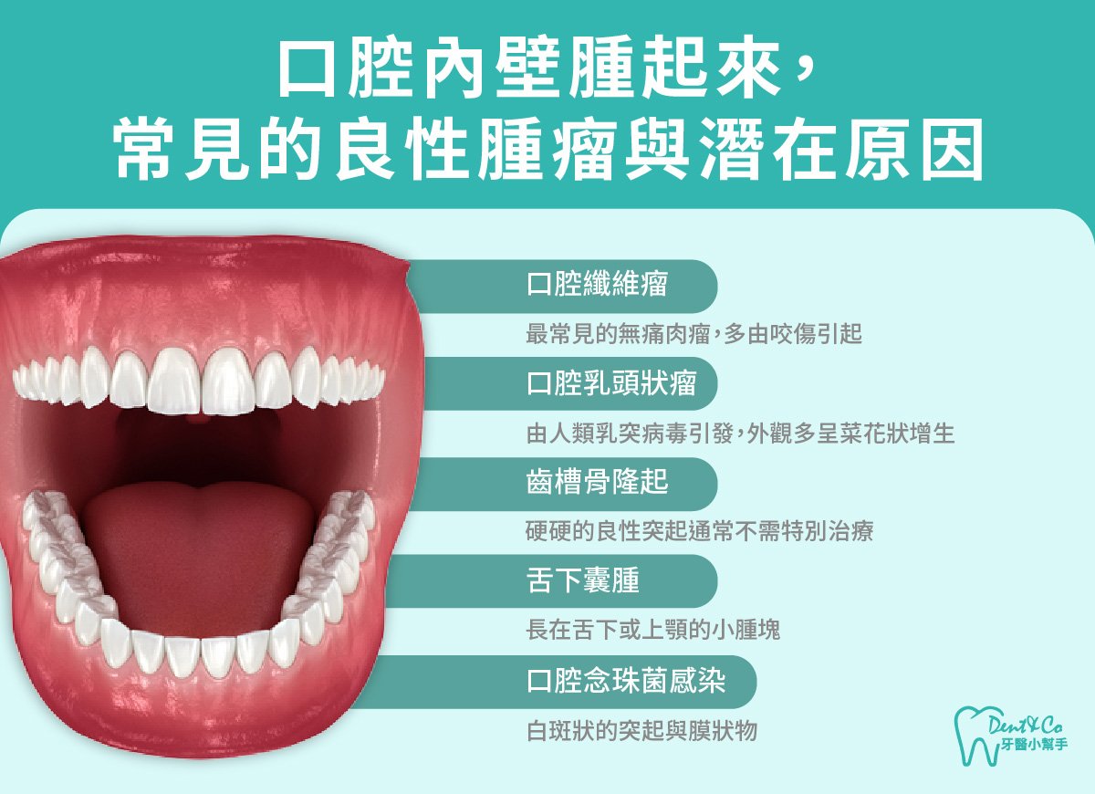 內文圖片-口腔內壁腫起來，常見的良性腫瘤與潛在原因.jpg
