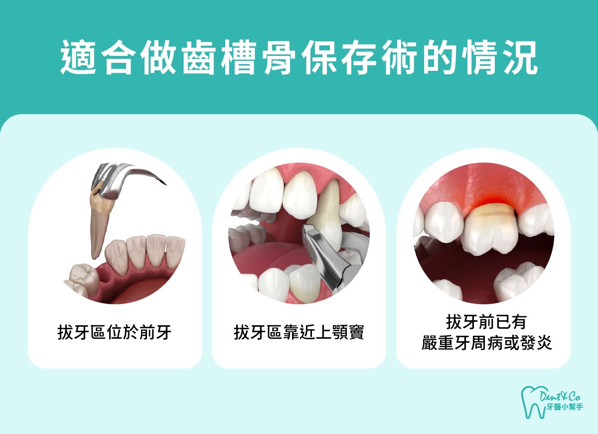 內文圖片-適合做齒槽骨保存術的情況.jpg