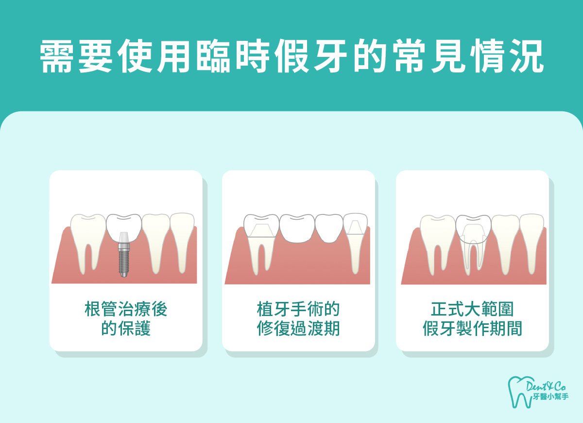 內文圖片-需要使用臨時假牙的常見情況.jpg
