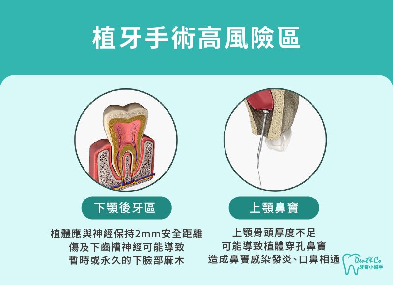 內文圖片-植牙手術高風險區.jpg