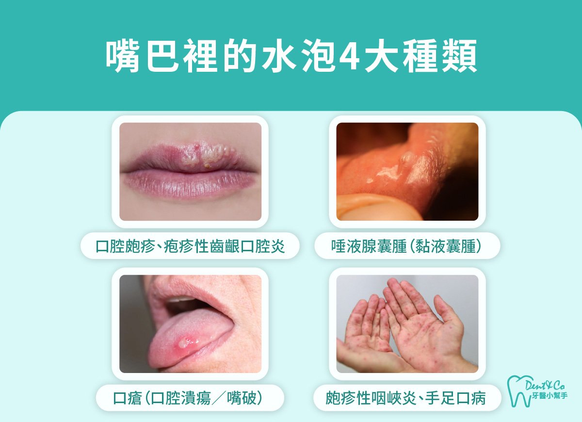 內文圖片-嘴巴裡的水泡4大種類.jpg