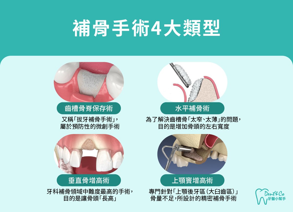 內文圖片- 補骨手術4大類型.jpg