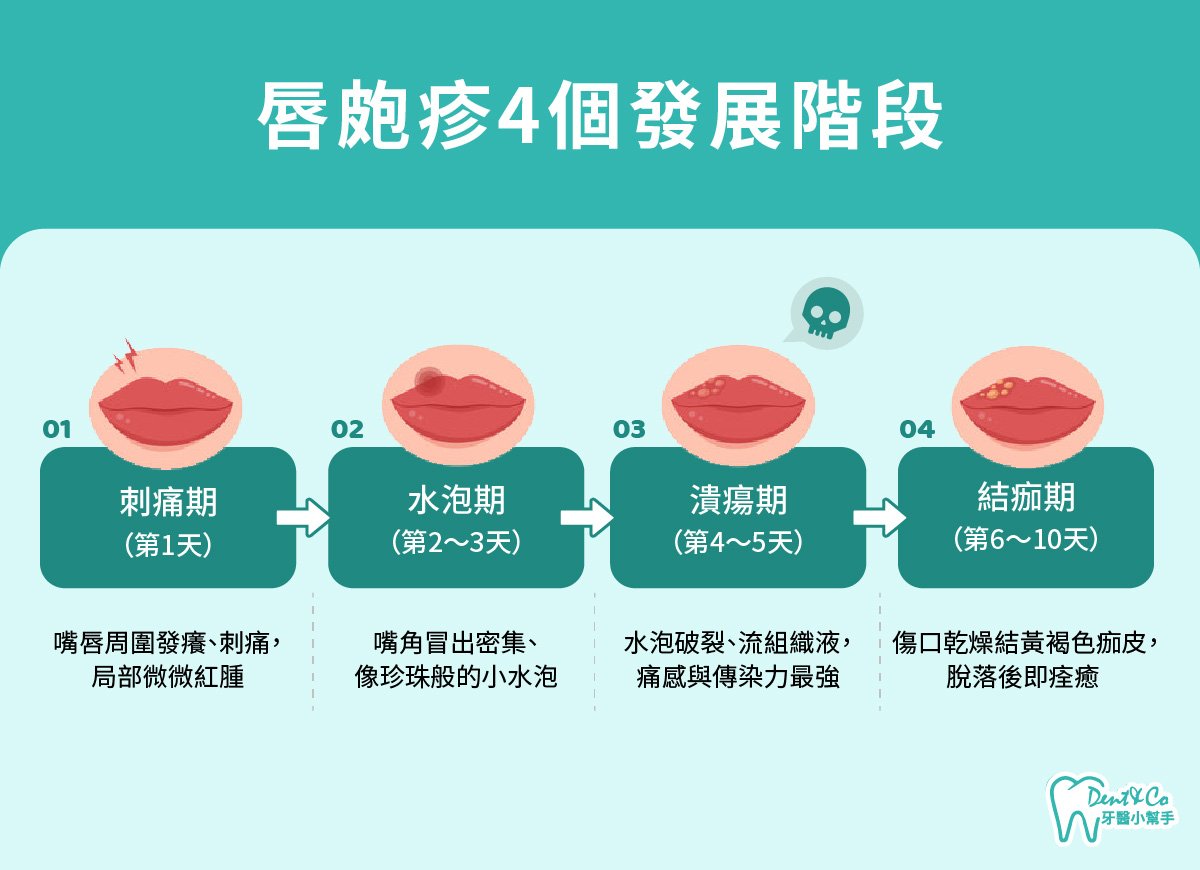 內文圖片- 唇皰疹4個發展階段.jpg