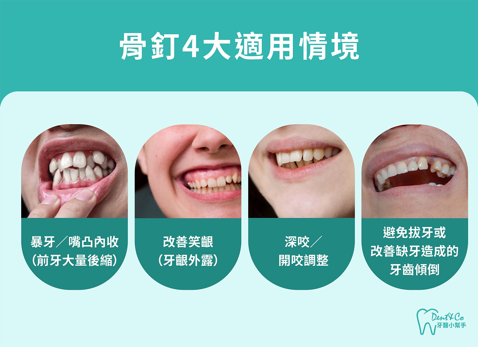 內文圖片- 骨釘4大適用情境.jpg