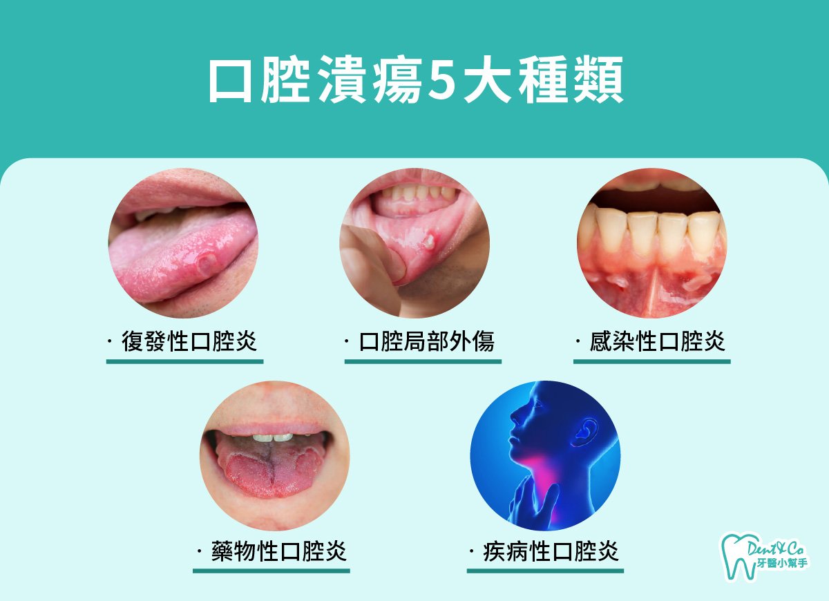 內文圖片- 口腔潰瘍5大種類.jpg