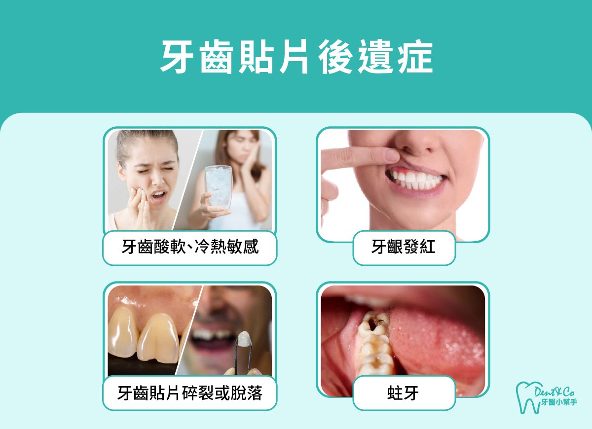 內文圖片- 牙齒貼片後遺症.jpg