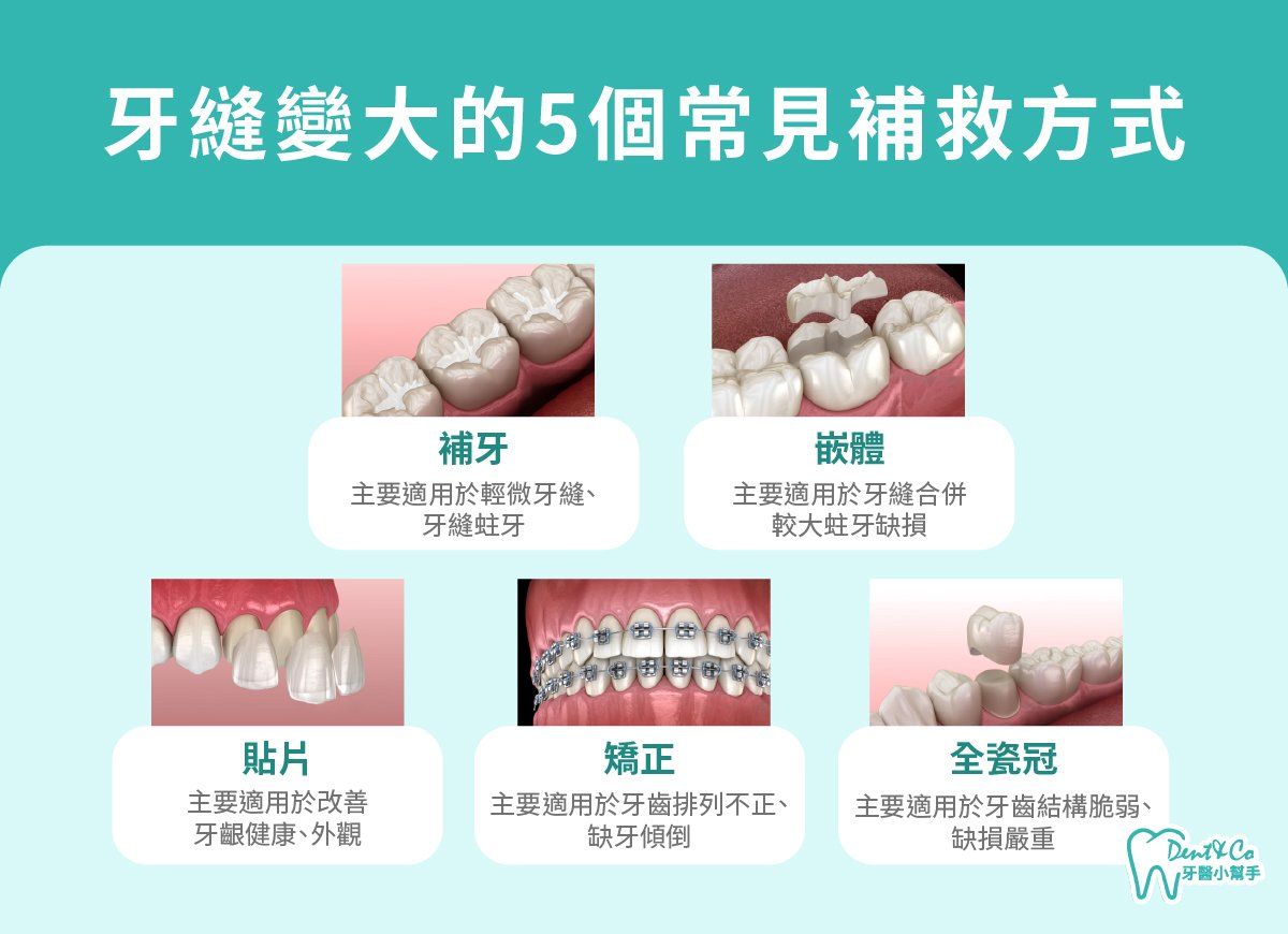 內文圖片- 牙縫變大的5個常見補救方式.jpg