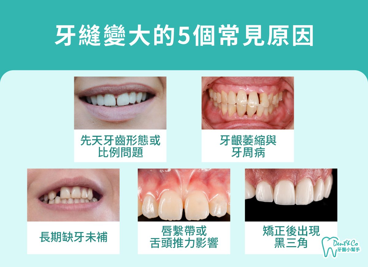 內文圖片- 牙縫變大的5個常見原因.jpg