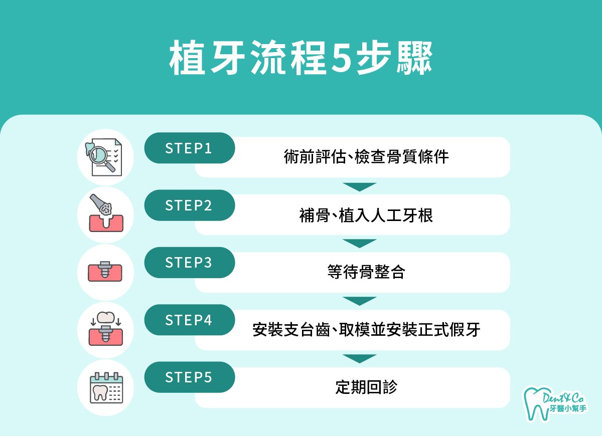 內文圖片- 植牙流程5步驟.jpg