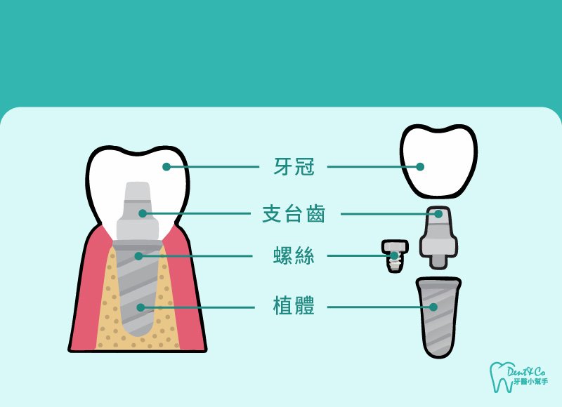 內文圖片- 植牙圖示.jpg