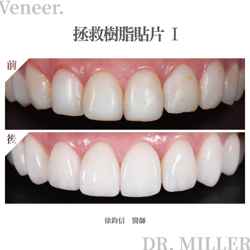 前牙美學案例分享二：拯救樹脂貼片-1.jpg