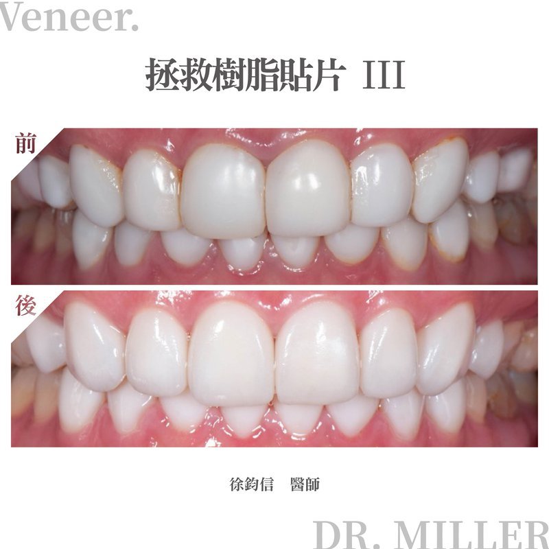 前牙美學案例分享二：拯救樹脂貼片-3.jpg
