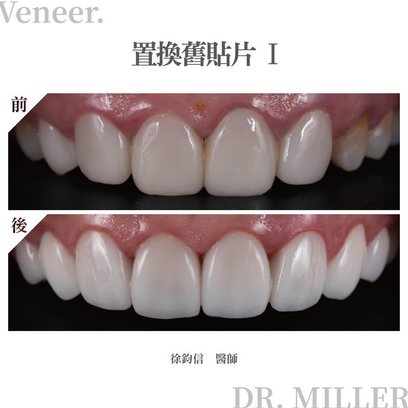 前牙美學案例分享三：置換舊貼片-1.jpg