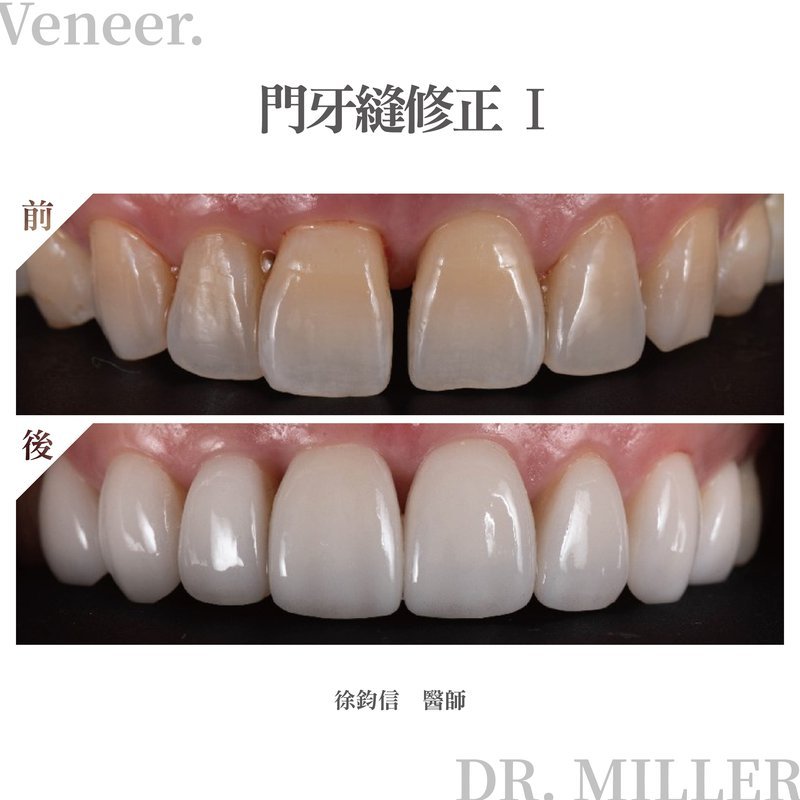 前牙美學案例分享四：門牙縫修正1.jpg