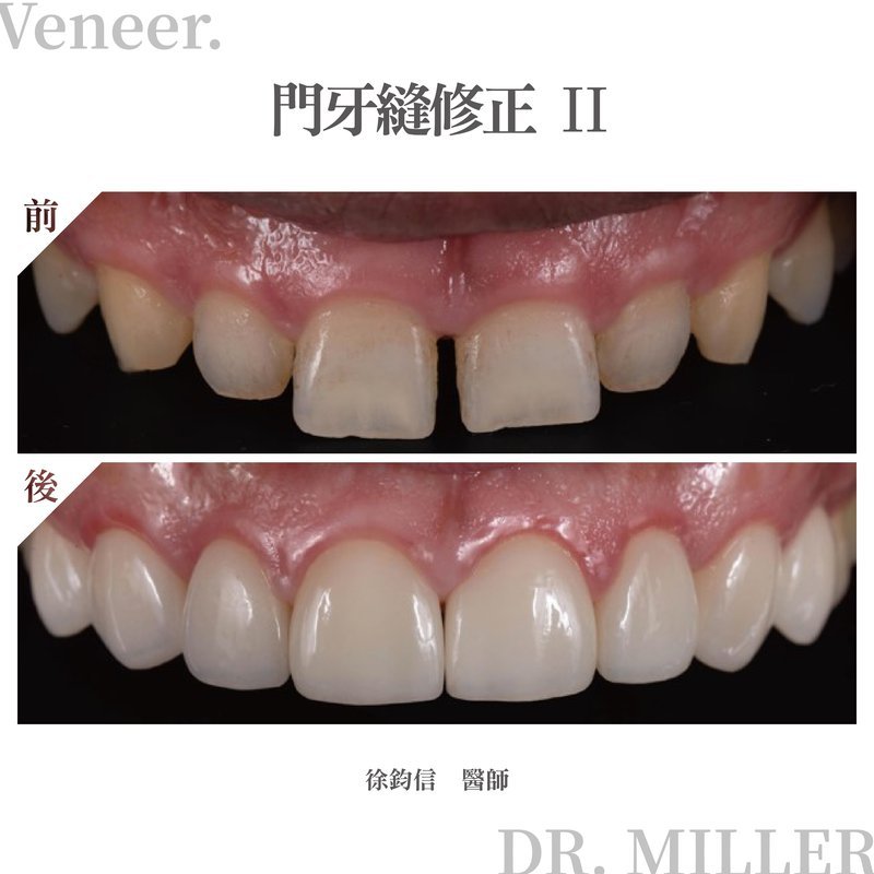 前牙美學案例分享四：門牙縫修正2.jpg