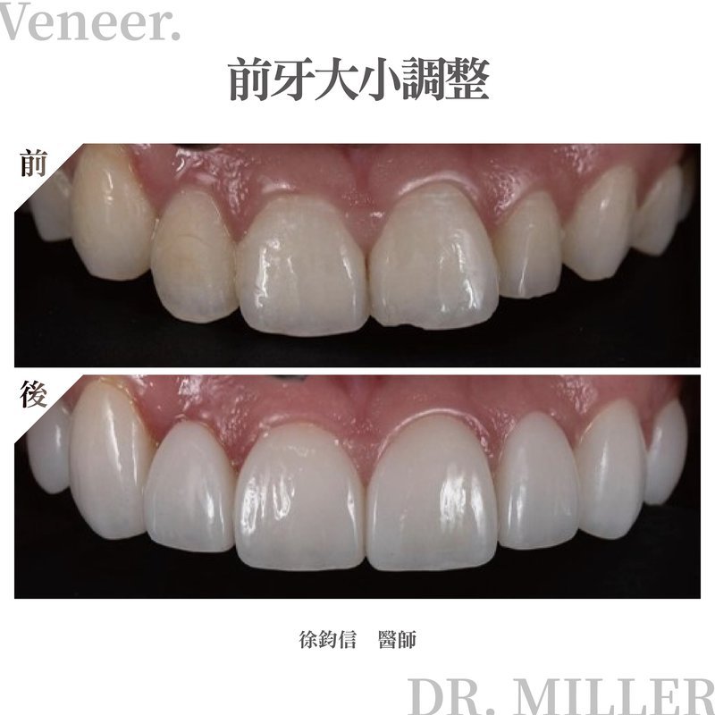 前牙美學案例分享四：前牙大小調整.jpg