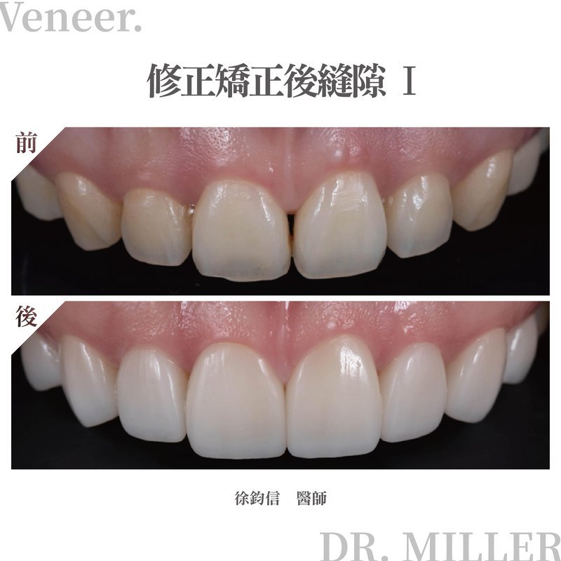 前牙美學案例分享四：修正矯正後縫隙1.jpg