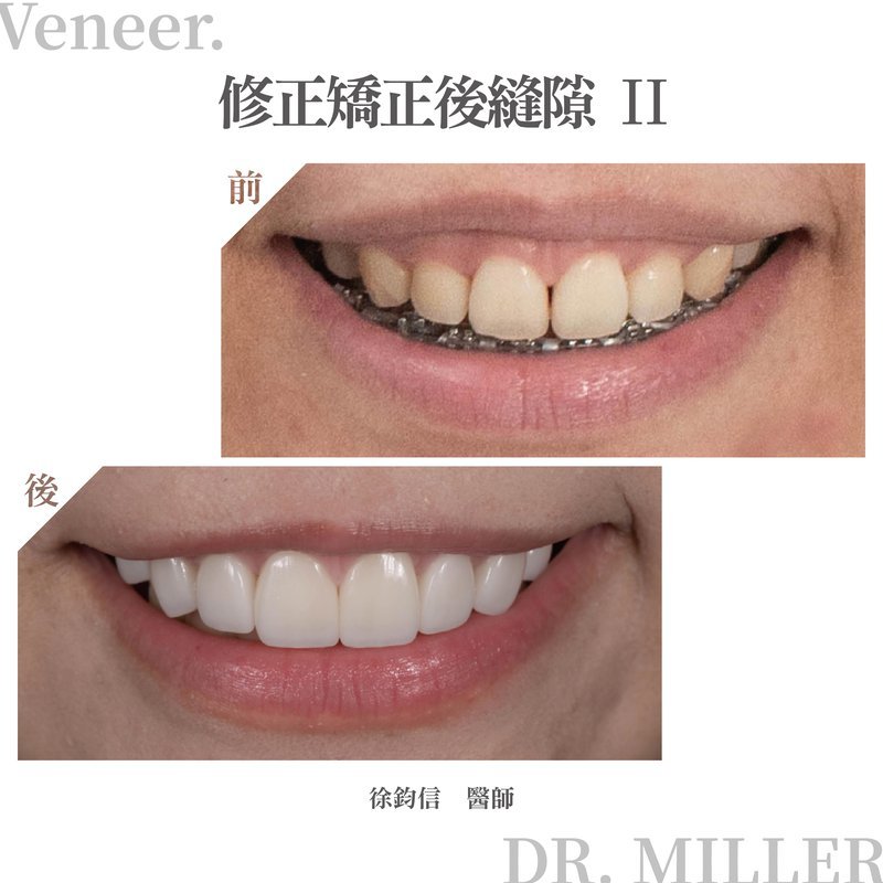 前牙美學案例分享四：修正矯正後縫隙2.jpg