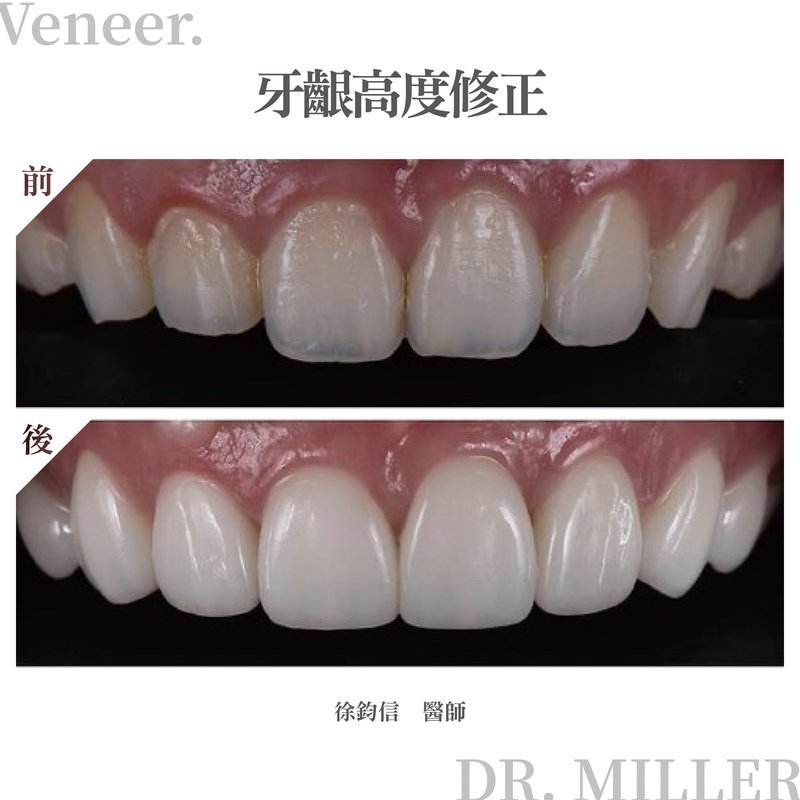 前牙美學案例分享四：牙齦高度修正.jpg