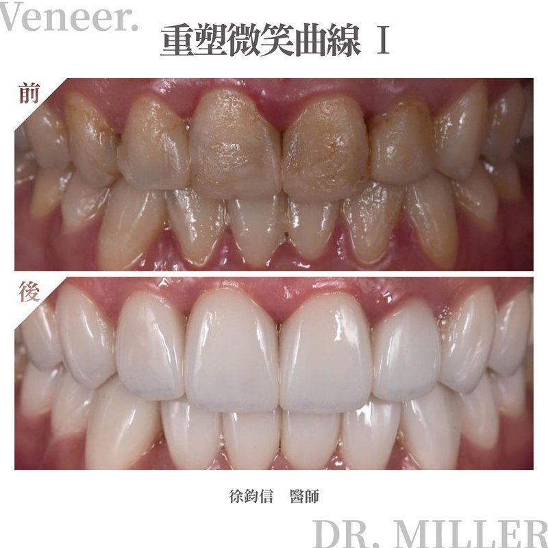 前牙美學案例分享五：貼片術前術後對比照＆人像完成照（重塑微笑曲線1）.jpg