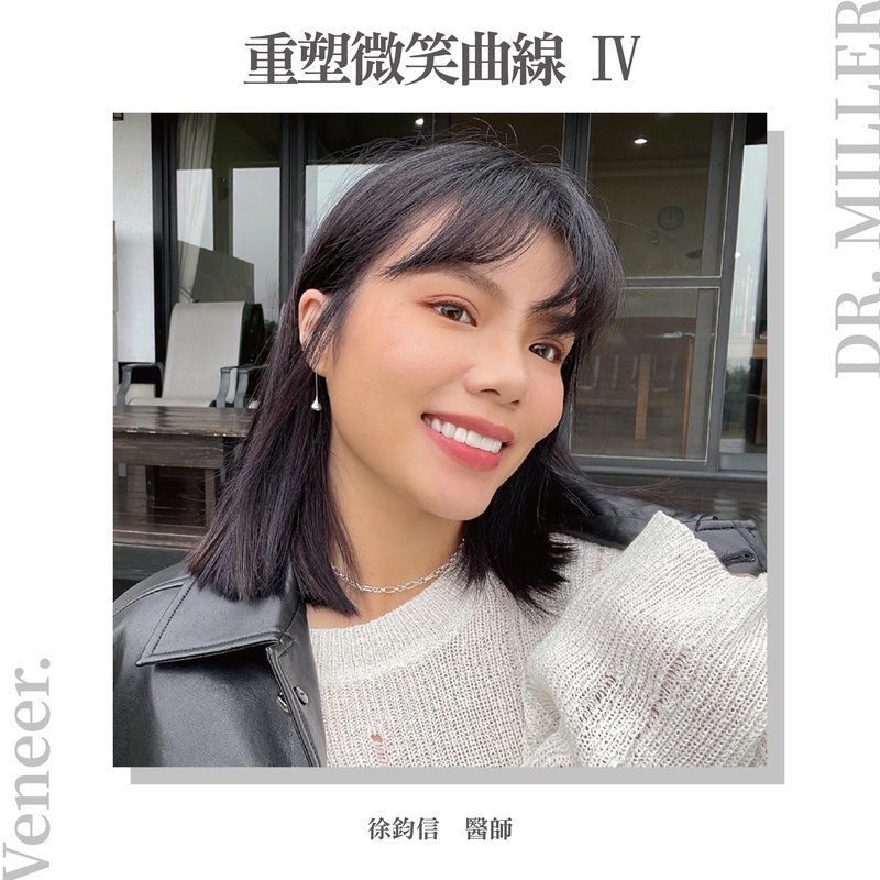 前牙美學案例分享五：貼片術前術後對比照＆人像完成照（重塑微笑曲線4）.jpg