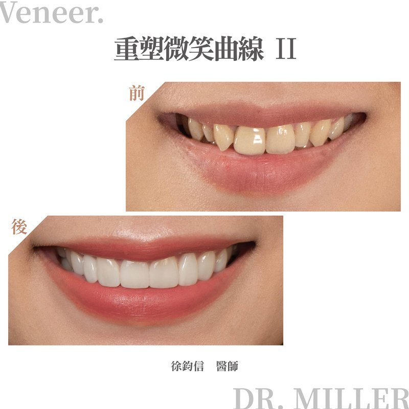 前牙美學案例分享五：貼片術前術後對比照＆人像完成照（重塑微笑曲線2）.jpg