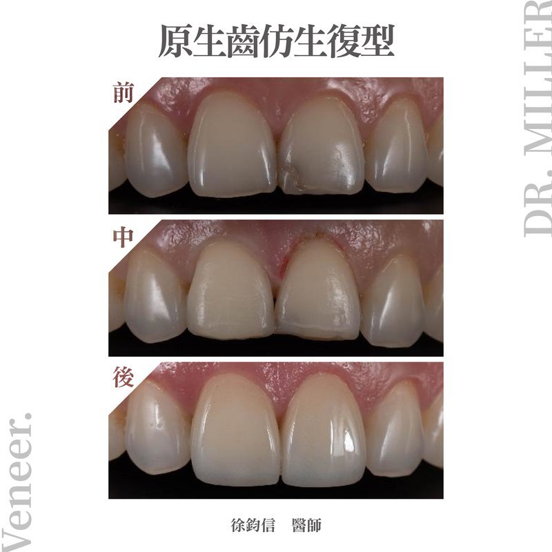 前牙美學案例分享五：貼片術前術後對比照＆人像完成照（原生齒仿生復型）.jpg