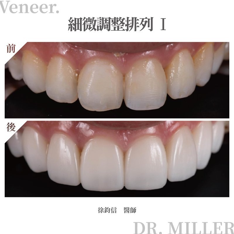 前牙美學案例分享一：細微調整排列-1.jpg