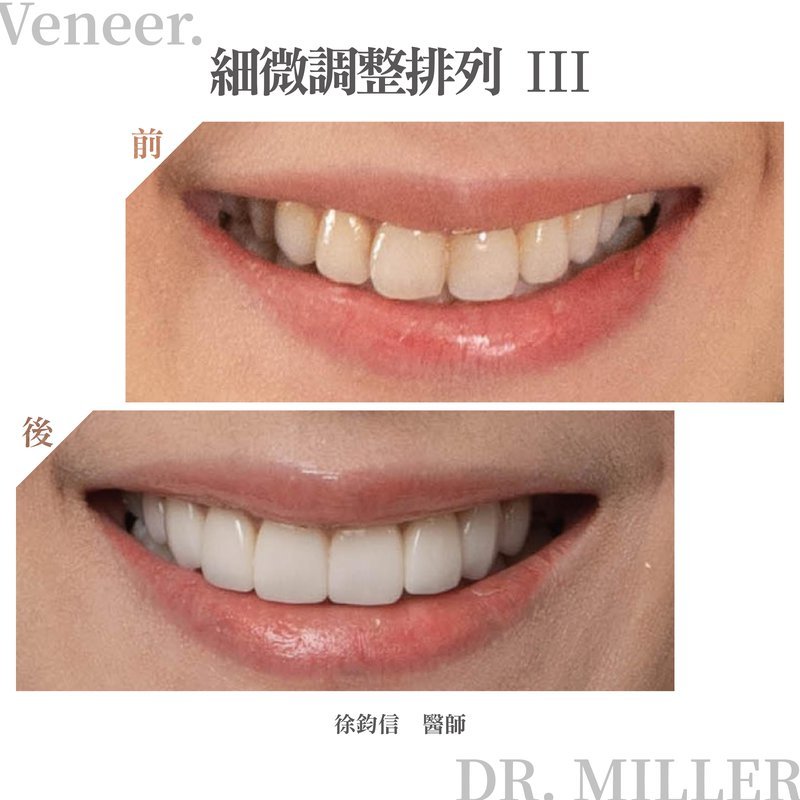 前牙美學案例分享一：細微調整排列-3.jpg